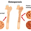 Logo Entrevista: Día Mundial de la Osteoporosis
