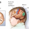 Logo Epilepsia ¿cómo se le explica a un niño?