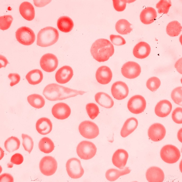 The Intersection 1 Bombay Blood Group Radiocut Lecture of the bombay blood group. radiocut